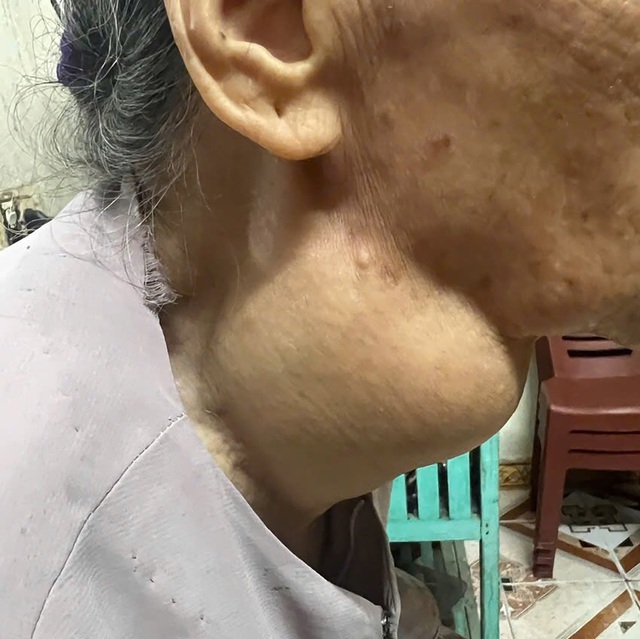Vinmec Hạ Long loại bỏ khối u gi&aacute;p khổng lồ 18 năm của cụ b&agrave; 88 tuổi - Ảnh 1.