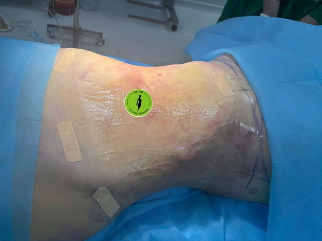 Đừng chỉ h&uacute;t mỡ bụng nếu bạn muốn c&oacute; một v&oacute;c d&aacute;ng chuẩn đồng hồ c&aacute;t! - Ảnh 3.