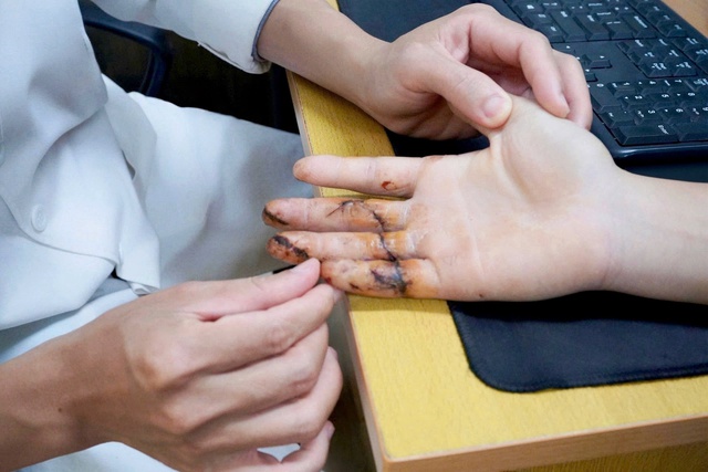 Ng&agrave;y đầu đi l&agrave;m mộc, nam thanh ni&ecirc;n bị m&aacute;y cưa cắt đứt 3 ng&oacute;n tay - Ảnh 1.