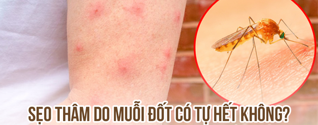 Bị sẹo thâm do muỗi đốt và côn trùng cắn có trị hết được không?- Ảnh 1.