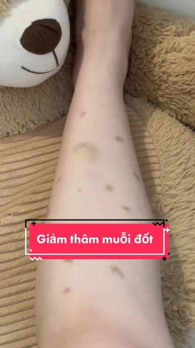 Bị sẹo thâm do muỗi đốt và côn trùng cắn có trị hết được không?- Ảnh 2.