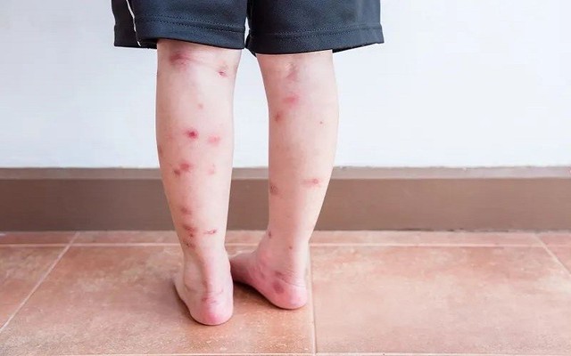 Bị sẹo thâm do muỗi đốt và côn trùng cắn có trị hết được không?- Ảnh 3.