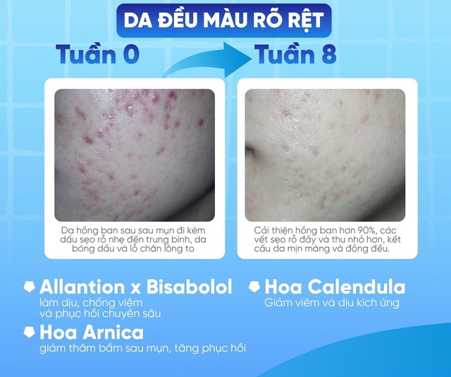 Sẹo đỏ sau mụn bao l&acirc;u th&igrave; hết? Đừng vội điều trị sai c&aacute;ch - Ảnh 4.