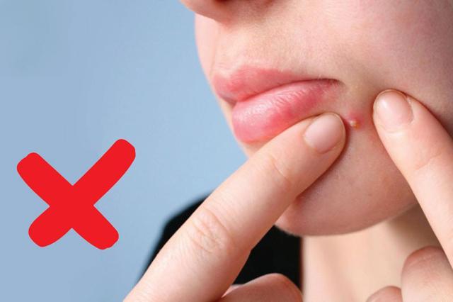 Có nên nặn mụn? Chia sẻ từ chuyên gia khiến nhiều người tiếc vì không biết sớm- Ảnh 2.