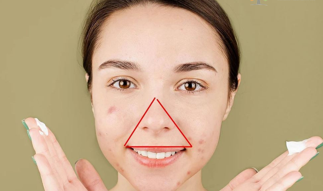 Có nên nặn mụn? Chia sẻ từ chuyên gia khiến nhiều người tiếc vì không biết sớm- Ảnh 4.