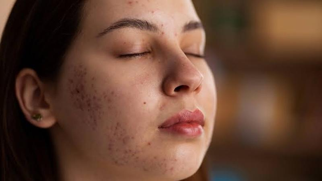'Cứu' làn da nhiễm corticoid và tổn thương do peel, laser sai cách - Ảnh 1.