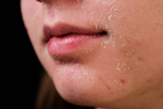 'Cứu' làn da nhiễm corticoid và tổn thương do peel, laser sai cách - Ảnh 2.
