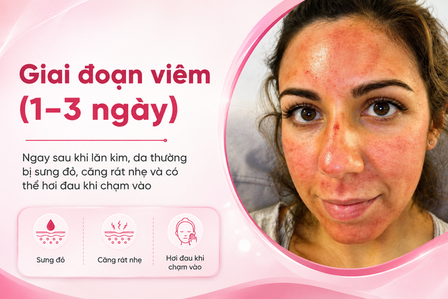 Chuyên gia bật mí cách ngừa sẹo sau lăn kim hiệu quả khiến ai cũng làm theo - Ảnh 3.