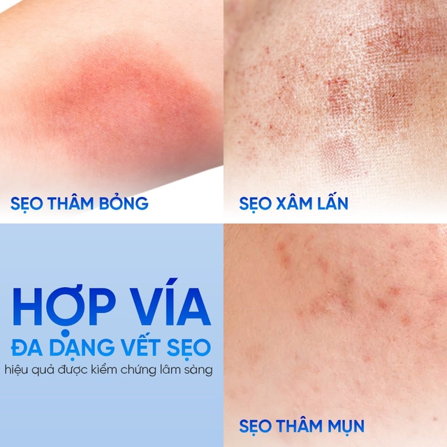 Chuyên gia bật mí cách ngừa sẹo sau lăn kim hiệu quả khiến ai cũng làm theo - Ảnh 10.
