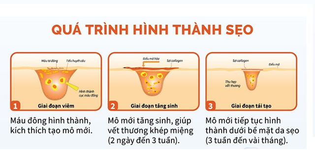 C&aacute;ch ngừa sẹo chuẩn y khoa cho l&agrave;n da phẳng mịn, ngừa sẹo kh&ocirc;ng kh&oacute; - Ảnh 2.