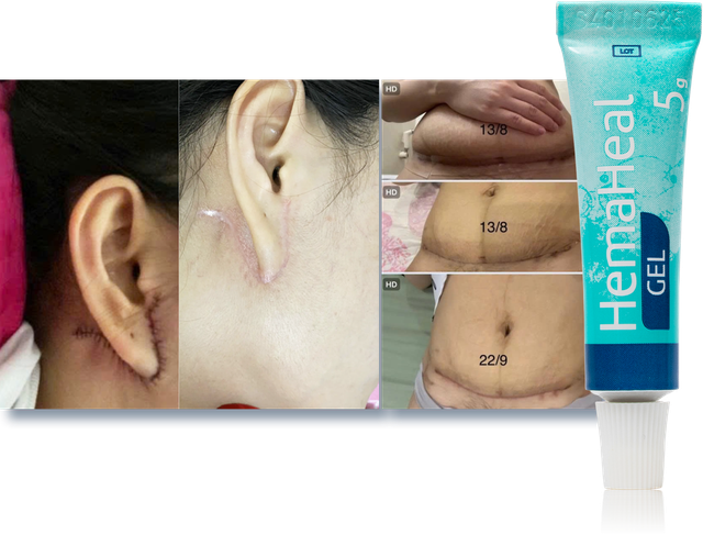 C&aacute;ch ngừa sẹo chuẩn y khoa cho l&agrave;n da phẳng mịn, ngừa sẹo kh&ocirc;ng kh&oacute; - Ảnh 5.