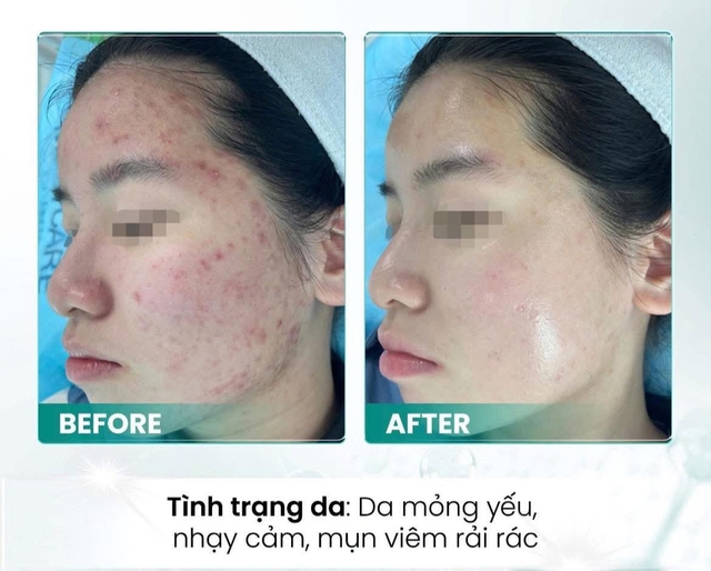 Top 5 kem dưỡng ẩm cho da dầu mụn mỏng mịn, không bóng nhờn, không bít tắc- Ảnh 6.