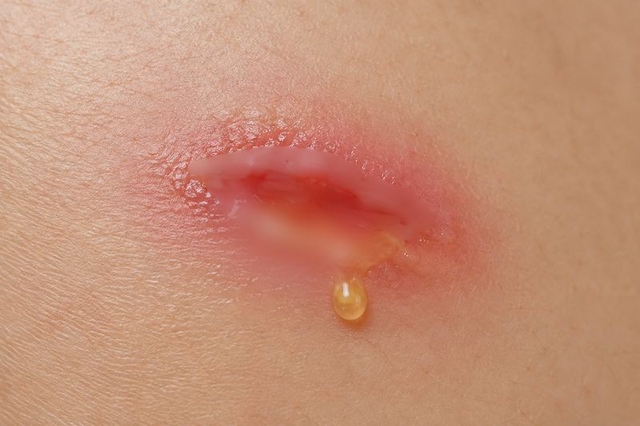 Vết thương bị rỉ nước: Kiểm so&aacute;t thế n&agrave;o để hỗ trợ l&agrave;nh thương? - Ảnh 1.