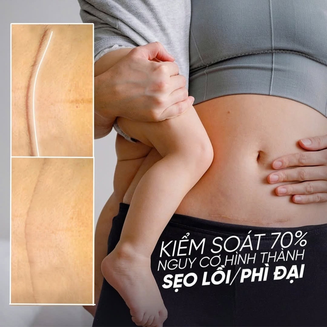 Mẹ sau sinh cần biết: Chăm s&oacute;c sẹo mổ đẻ n&ecirc;n bắt đầu từ khi n&agrave;o?- Ảnh 5.