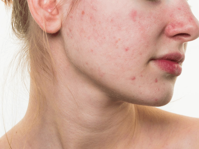 Trioderma Intensive Acne Spot Gel và bài toán chấm mụn không làm khô da - Ảnh 1.
