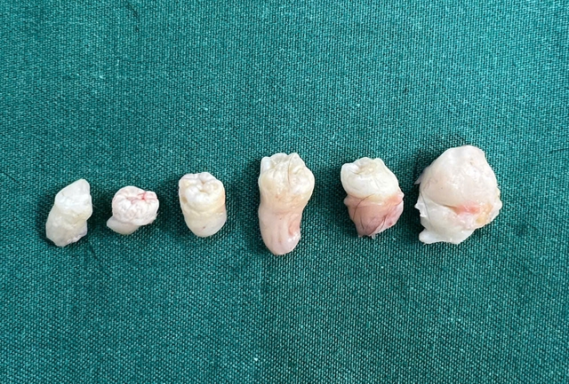 Phẫu thuật nội soi lấy 6 chiếc răng trong bụng nữ bệnh nhân- Ảnh 1.