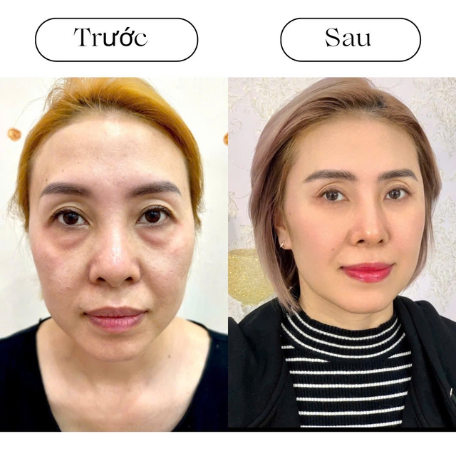Xóa tan quầng thâm mắt bằng công nghệ Hydro Ultra Lift- Ảnh 1.