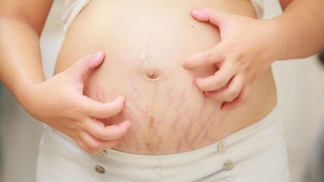 Có kem bôi rạn da đỏ nào phù hợp cả mẹ bầu và tuổi dậy thì không?- Ảnh 2.