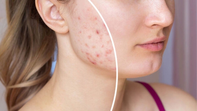 Mụn m&atilde;i kh&ocirc;ng hết, chuy&ecirc;n gia da liễu chỉ ra nguy&ecirc;n nh&acirc;n kh&ocirc;ng ai ngờ tới- Ảnh 1.