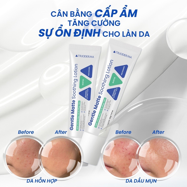 Mụn m&atilde;i kh&ocirc;ng hết, chuy&ecirc;n gia da liễu chỉ ra nguy&ecirc;n nh&acirc;n kh&ocirc;ng ai ngờ tới- Ảnh 5.