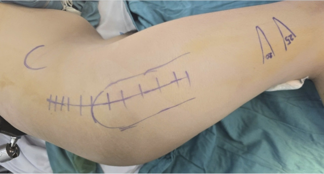 B&eacute; 14 tuổi mắc bệnh l&yacute; chất trắng ở n&atilde;o, tho&aacute;t cảnh &lsquo;năm n&agrave;o cũng phải mổ&rsquo;- Ảnh 1.