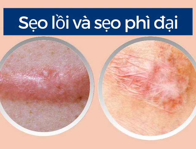 Có cách nào ngừa sẹo từ vết khâu cho da từng đụng dao kéo vẫn láng mịn?- Ảnh 4.