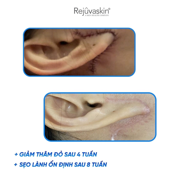 Có cách nào ngừa sẹo từ vết khâu cho da từng đụng dao kéo vẫn láng mịn?- Ảnh 8.