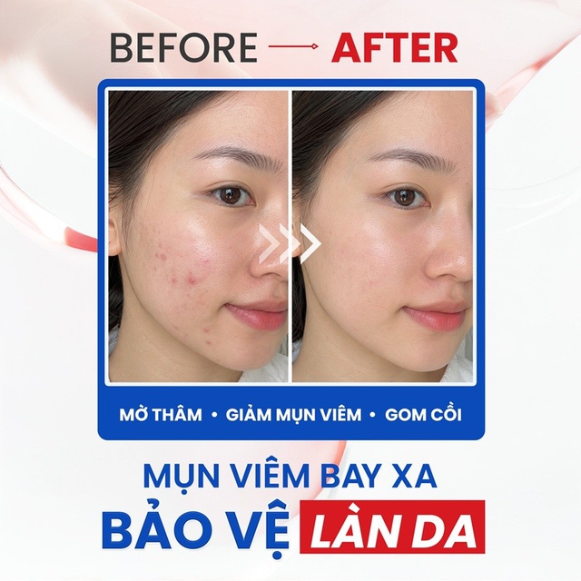 Top 5 kem chấm mụn giúp mụn viêm sưng xẹp sau khoảng 1 đêm ngừa sẹo thâm- Ảnh 1.