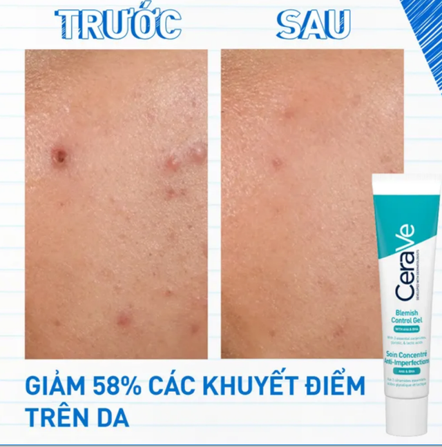 Top 5 kem chấm mụn giúp mụn viêm sưng xẹp sau khoảng 1 đêm ngừa sẹo thâm- Ảnh 6.