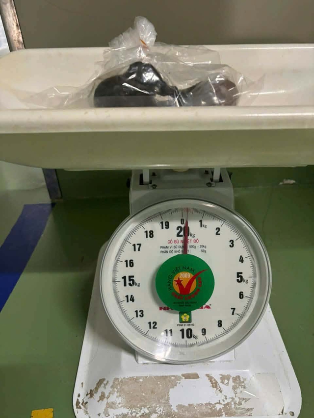 Thói quen ăn tóc khiến bé gái 5 tuổi phải phẫu thuật lấy khối tóc 250 gram- Ảnh 1.