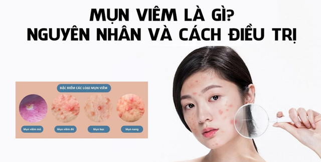 Bị mụn viêm sưng nên nặn không? Cần làm gì hết mụn mà không để lại sẹo?- Ảnh 1.