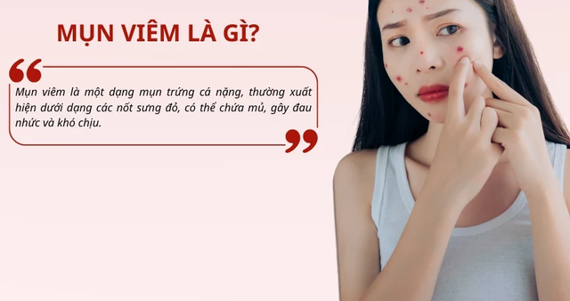 Bị mụn viêm sưng nên nặn không? Cần làm gì hết mụn mà không để lại sẹo?- Ảnh 2.