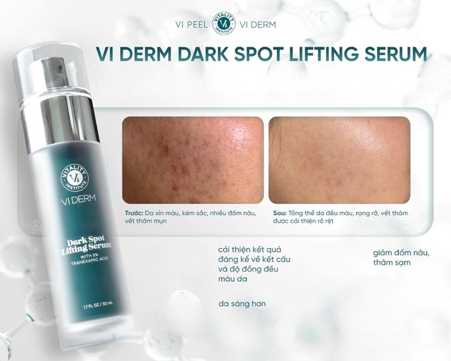 Top 6 serum mờ nám, tàn nhang sau khoảng 4 tuần khiến chị em đều không tin - Ảnh 2.