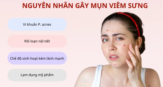 Bị mụn viêm sưng nên nặn không? Cần làm gì hết mụn mà không để lại sẹo?- Ảnh 3.