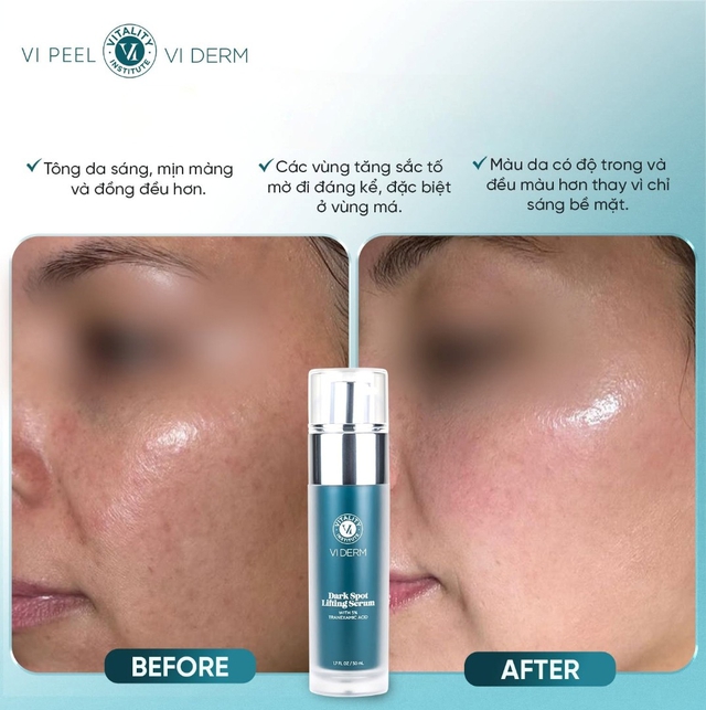Top 6 serum mờ nám, tàn nhang sau khoảng 4 tuần khiến chị em đều không tin - Ảnh 3.