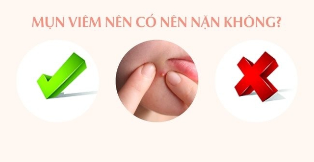 Bị mụn viêm sưng nên nặn không? Cần làm gì hết mụn mà không để lại sẹo?- Ảnh 4.