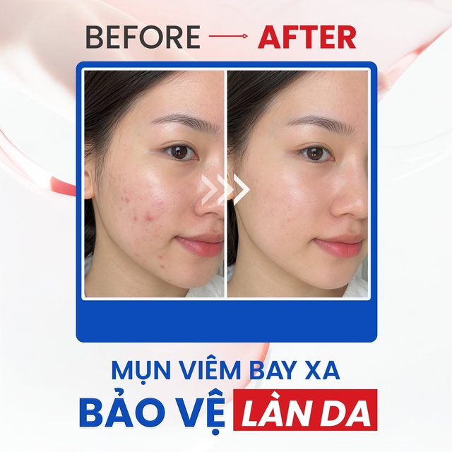 Review kem chấm mụn viêm Trioderma Intensive Acne Spot Gel thật sự hiệu quả sau lần đầu? - Ảnh 6.