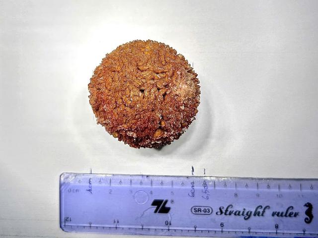 Người đ&agrave;n &ocirc;ng mang vi&ecirc;n sỏi nặng gần 100 g suốt 20 năm - Ảnh 3.