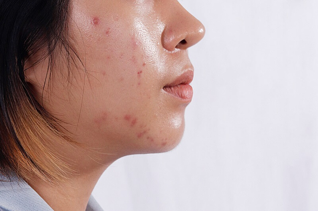 Vì sao mụn không dứt dù skincare đều đặn? Giải pháp cùng dược mỹ phẩm Việt Trioderma- Ảnh 1.