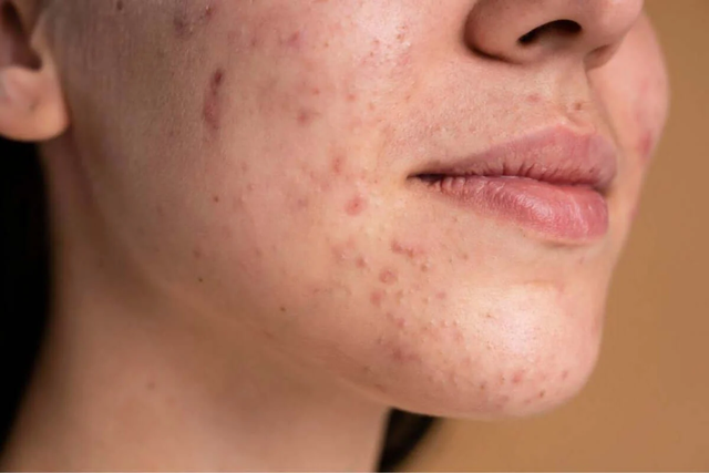 Vì sao mụn không dứt dù skincare đều đặn? Giải pháp cùng dược mỹ phẩm Việt Trioderma- Ảnh 2.