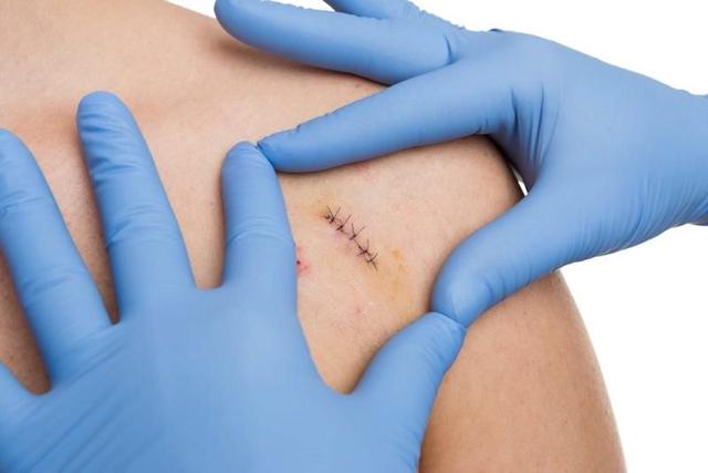 Plasma Cold: Hướng đi mới giúp rút ngắn thời gian lành thương sau phẫu thuật - Ảnh 1.