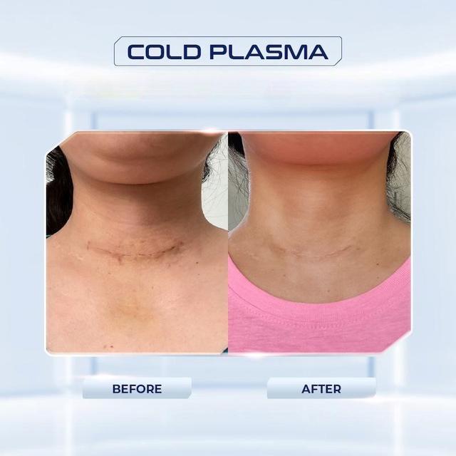 Plasma Cold: Hướng đi mới giúp rút ngắn thời gian lành thương sau phẫu thuật - Ảnh 3.
