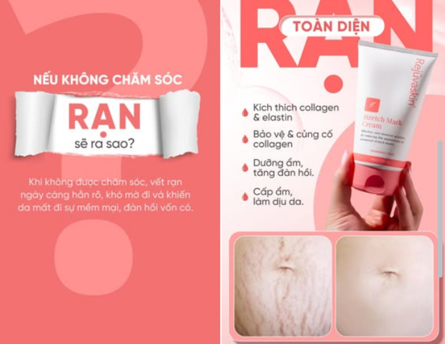 Kem xóa mờ rạn da nào hiệu quả với rạn da trắng - Chuyên gia nói gì? - Ảnh 1.