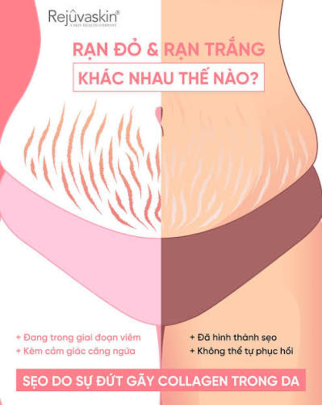Kem xóa mờ rạn da nào hiệu quả với rạn da trắng - Chuyên gia nói gì? - Ảnh 3.