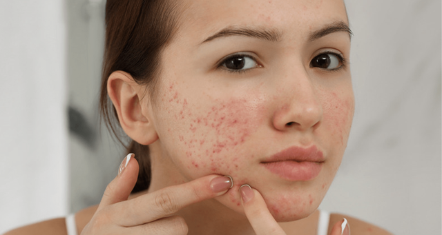 Gel chấm mụn viêm Trioderma Intensive Acne Spot : Mảnh ghép mới chăm sóc da dầu mụn - Ảnh 1.