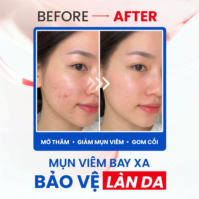 Gel chấm mụn viêm Trioderma Intensive Acne Spot : Mảnh ghép mới chăm sóc da dầu mụn - Ảnh 5.