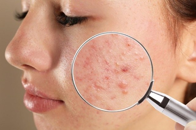 Quy trình skincare cho da dầu mụn ban đêm chuẩn y khoa hiệu quả bất ngờ- Ảnh 2.