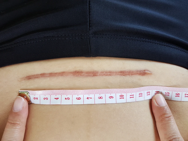 Đứng trước gương 6 tuần sau sinh, mẹ có nên quan tâm vết sẹo mổ sau sinh?- Ảnh 1.