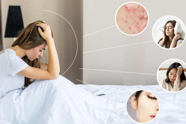 Mụn không chỉ là câu chuyện tuổi dậy thì: Vì sao người trưởng thành vẫn bị mụn?- Ảnh 2.