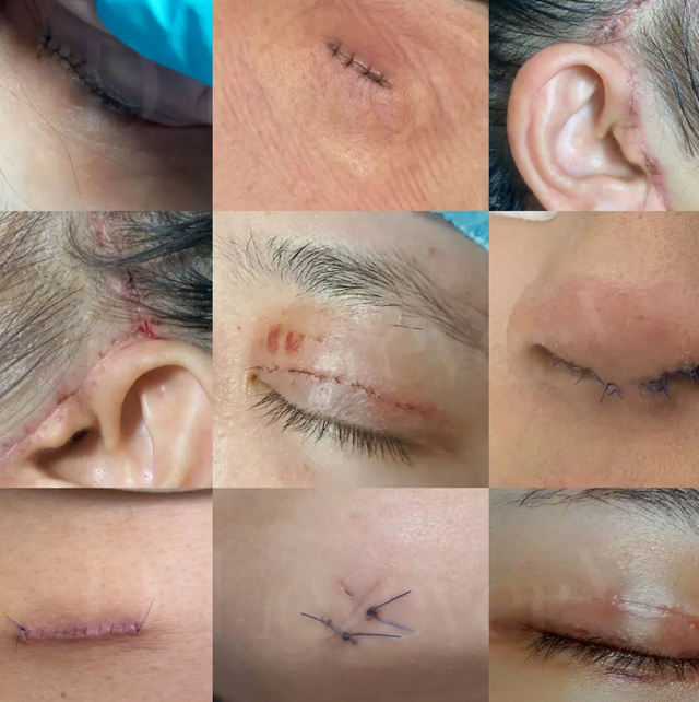 Kem mờ sẹo sau cắt chỉ nào được tìm mua nhiều và chuyên gia tin dùng?- Ảnh 2.